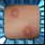 Ringworm Home Treatment